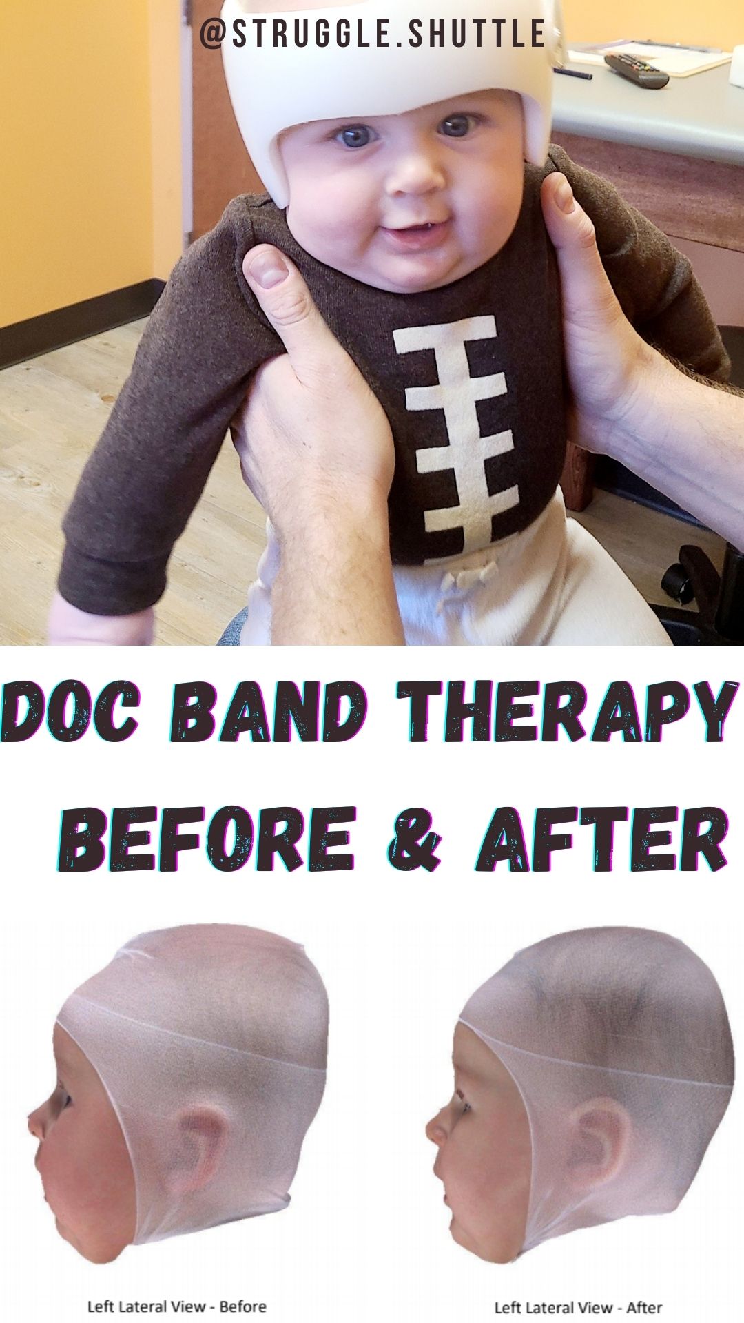 Doc Band Before and After | Brachycephaly - Struggle Shuttle